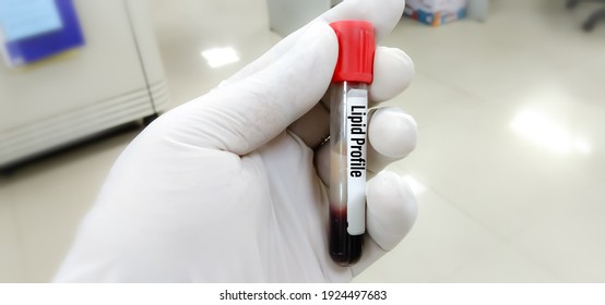 Blood Sample For Lipid Profile Testing With Lipemic Serum