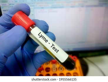 Blood Sample For Lyme Disease Testing