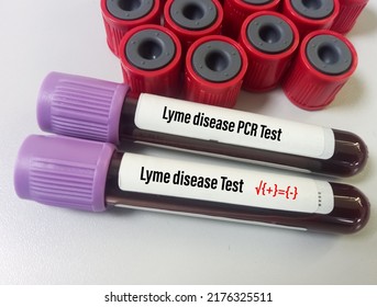 Blood sample for Lyme disease testing at laboratory.