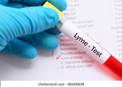 Blood Sample For Lyme Disease Testing