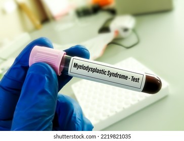 Blood Sample For Myelodysplastic Syndrome Test. 