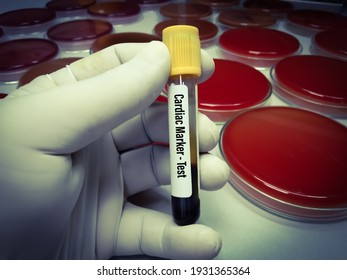 Blood Sample For N-terminal Pro B-type Natriuretic Peptide Or NT-proBNP Test, Cardiac Marker For Acute Or Chronic Heart Failure