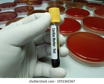 Blood Sample For N-terminal Pro B-type Natriuretic Peptide Or NT-proBNP Test, Cardiac Marker For Acute Or Chronic Heart Failure