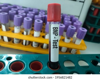 Blood Sample For N-terminal Pro B-type Natriuretic Peptide Or NT-proBNP Test, Cardiac Marker For Acute Or Chronic Heart Failure