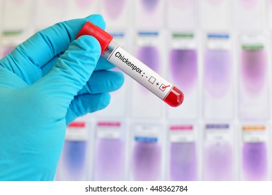 Blood Sample Positive With Chickenpox Virus