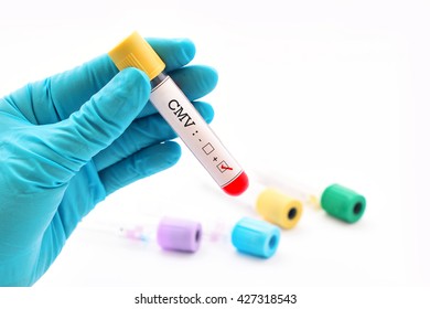 Blood Sample Positive With Cytomegalovirus (CMV)