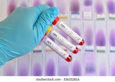 Blood Sample Positive With Hepatitis A, B, C Virus