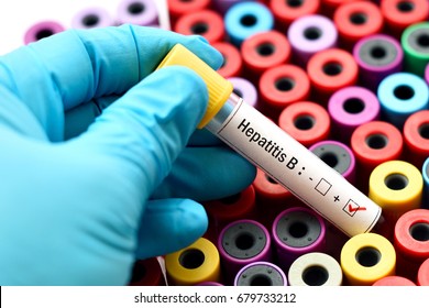 Blood Sample Positive With Hepatitis B Virus