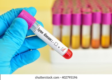 Blood sample positive with Lyme disease 
