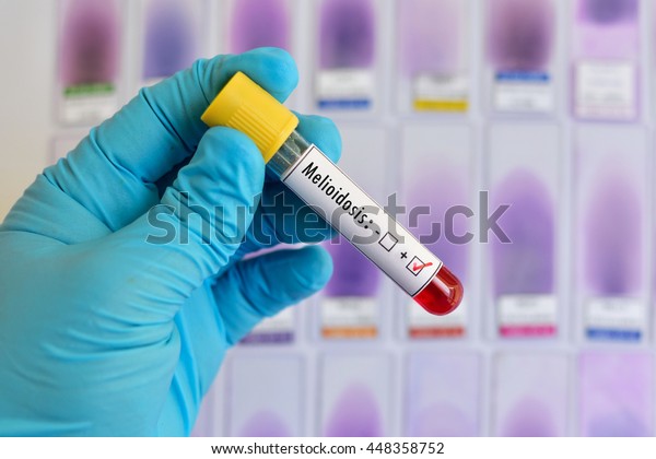 Blood Sample Positive Melioidosis Test Stock Photo 448358752 | Shutterstock