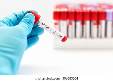 Blood Sample Positive With Mumps Virus