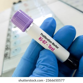 Blood sample for Proliferation marker Ki-67 test, to diagnosis of breast cancer.