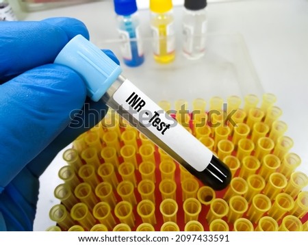 Blood Sample for Prothrombin time (P.T), international normalized ratio (INR) test. Blood coagulation testing. Medical or health concept. P. Time