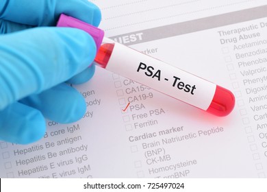 Blood sample for PSA (prostate specific antigen) test, diagnosis for prostate cancer