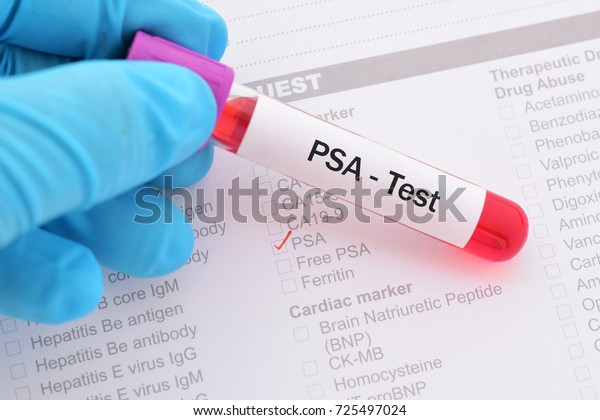 Blood Sample Psa Prostate Specific Antigen Stock Photo (Edit Now) 725497024