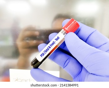 Blood sample for PSA Total and PSA Free test at medical laboratory.