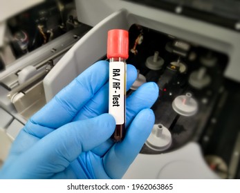 Blood Sample RARF Test. Rheumatoid Factor. Rheumatoid Arthritis.