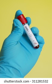 Blood Sample With SARS (Severe Acute Respiratory Syndrome) Virus Positive