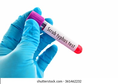 Blood Sample For Scrub Typhus Test
