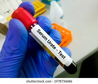 Blood Sample For Serum Urate Test. Uric Acid