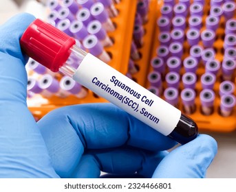 Blood sample for Squamous cell carcinoma(SCC) test,  to diagnosis of small cell lung cancer. skin cancer.