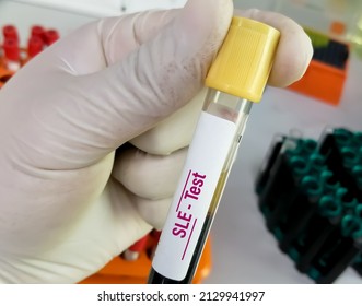 Blood Sample For Systemic Lupus Erythematosus (SLE) Test. Autoimmune Disease