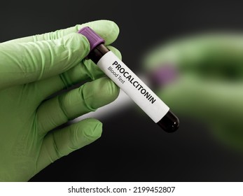 Blood Sample Test Of Procalcitonin Used For Diagnosis Of Sepsis, Organ Rejection, Respiratory Illnesses, Cardiovascular Disease, Meningitis, Kidney Disease, Hepatitis. Laboratory Blood Test Tube