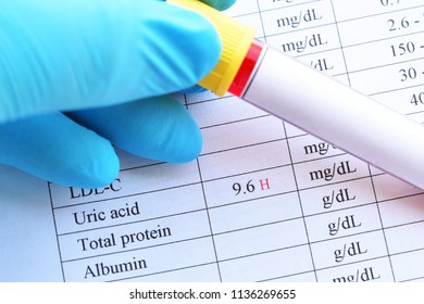 Blood Sample Tube With Abnormal High Uric Acid Test Result