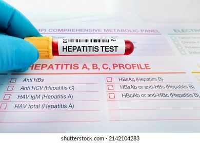 Blood Sample Tube Analysis Hepatic Test Stock Photo 2142104283 ...