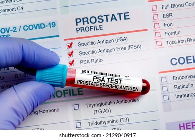 Blood sample tube for analysis of PSA Prostate Specific Antigen profile test in laboratory. Blood tube test with requisition form for PSA Prostate Specific Antigen test