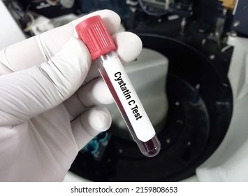 Blood Sample Tube For Cystatin C Test, Diagnosis For Renal Disease, Kidney Disease