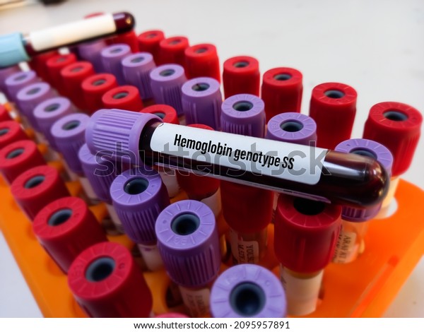 Blood sample
tube with blood for Hemoglobin genotype SS-test, hemoglobin
evaluation, sickle cell screen, focus
view