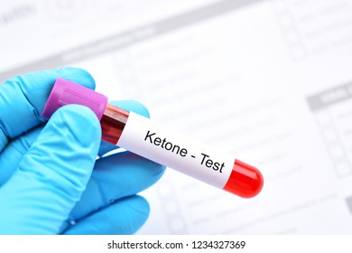 Blood Sample Tube For Ketone Test, Diagnosis For Diabetic Ketoacidosis