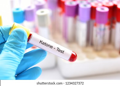 Blood Sample Tube For Ketone Test, Diagnosis For Diabetic Ketoacidosis