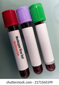 Blood Sample Tube For Monkeypox Virus Test(West African Clade). Double-stranded DNA, Zoonotic Virus And A Species Of The Genus Orthopoxvirus In The Family Poxviridae.