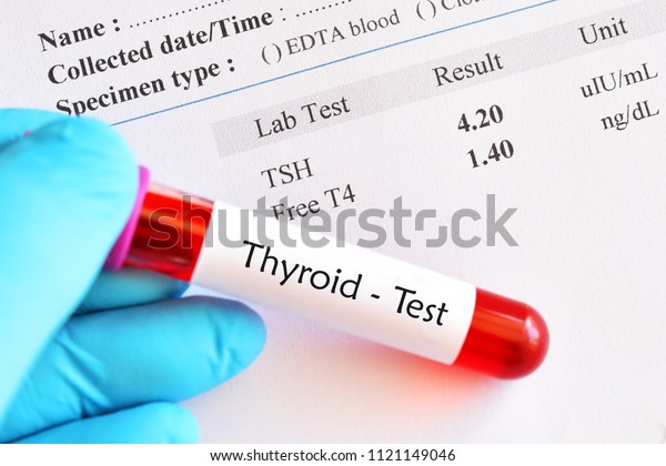 Blood Sample Tube Normal Thyroid Hormone Stock Photo (Edit Now) 1121149046