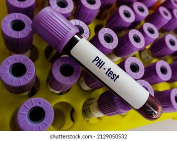 Blood sample tube with sample for PHI(Prostate Health Index) test. Prostate specific antigen, combined all three forms(total PSA, free PSA and p2PSA), for prostate cancer