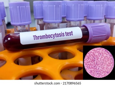 Blood Sample Tube For Thrombocytosis Test With Microscopic View, Abnormal Cells In The Bone Marrow Cause An Increase In Platelets. It Is Also Called Essential Thrombocythemia (ET).