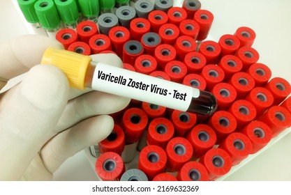 Blood sample tube for Varicella zoster virus or VZV test.