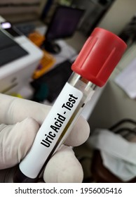 Blood Sample For Uric Acid Test For Gout Diagnosis