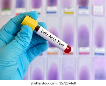 Blood Sample For Uric Acid Test (Gout Diagnosis)