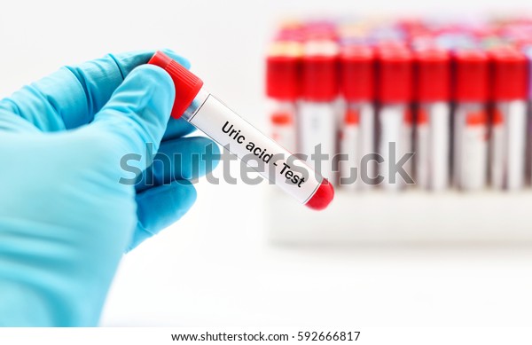 what-blood-test-shows-uric-acid-levels