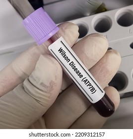 Blood Sample For Wilson Disease(ATP7B) Test, Rare Or Orphan Disease, Molecular Genetics Test.