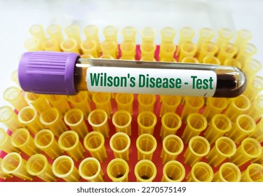 Blood sample for wilson's disease test. ATP7B.