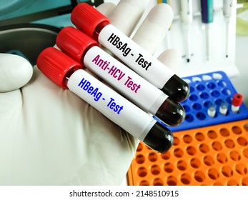 Blood Samples For Hepatitis Virus Test (Hepatitis A, B, C And E). To Diagnosis Viral Hepatitis