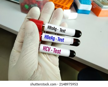 Blood Samples For Hepatitis Virus Test (Hepatitis A, B, C And E). To Diagnosis Viral Hepatitis