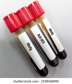 Blood Samples For Hepatitis Virus Test (Hepatitis B, C, E). To Diagnosis Viral Hepatitis.