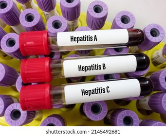 Blood Samples Tube With Sample For Hepatitis Virus Test (Hepatitis A, Hepatitis B, Hepatitis C)