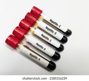 Blood Samples Tube With Sample For Hepatitis Virus Panel Test (Hepatitis A,B,C,D,E). Hepatitis Antibody And Antigen Tests.