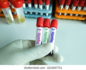 Blood Samples Tube With Sample For Hepatitis Virus Test (Hepatitis A, Hepatitis B, Hepatitis C)